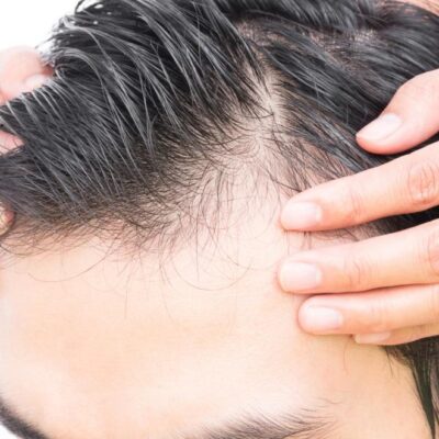 How to treat hair loss